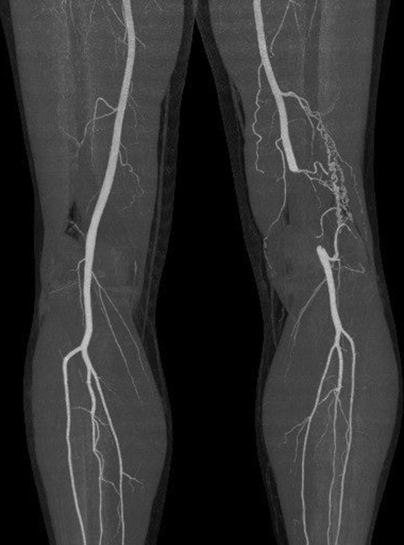 Read more about the article Exercise induced Leg Pain due to Vascular Compression Syndrome